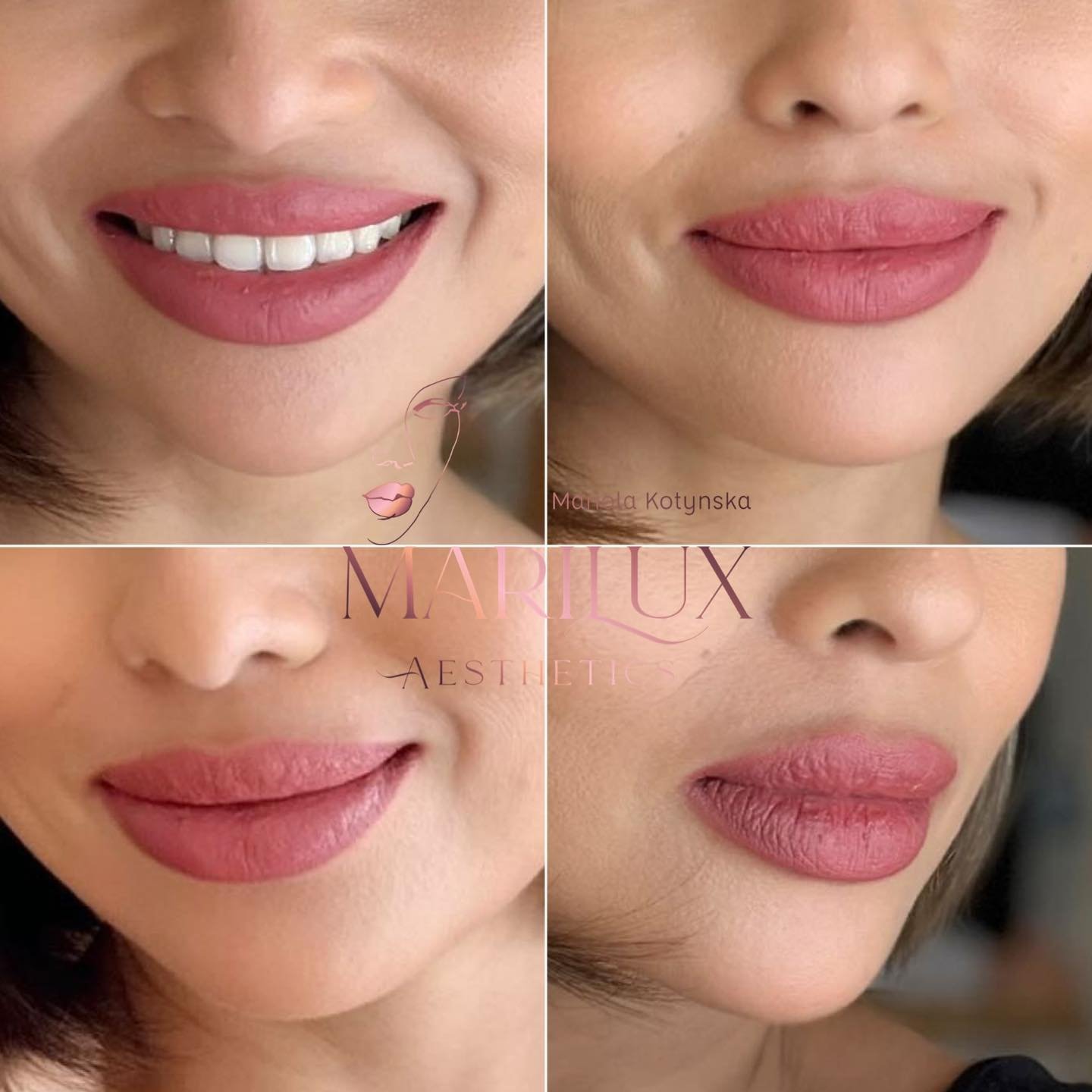 Lip filler result 5 — natural looking enhancement